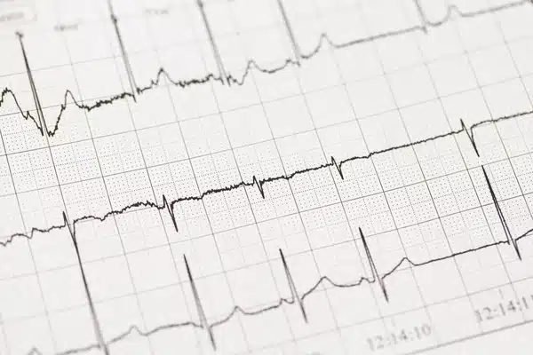 EKG Nedir? EKG Nasıl Çekilir?